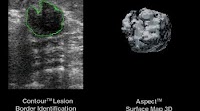 U-Systems develops CAD tools for breast ultrasound