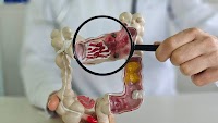 Why More Young Adults Are Getting Colorectal Cancer