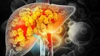Von der Fettleber zum hepatozellulären Karzinom