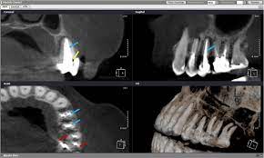 cbct images that represent artifacts