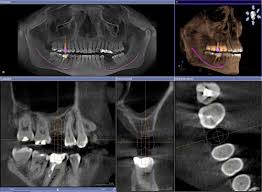 le scanner dentaire cone beam