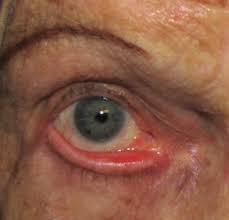 lower eyelid woolfson eye insute