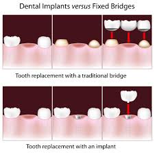 bridge vs implant charleston center