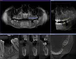 panoramique dentaire radiologie