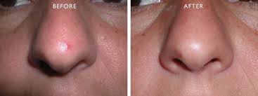 v beam laser patient before and after