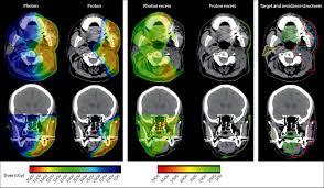 proton therapy for head and neck cancer