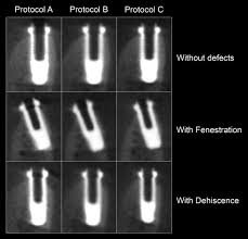 detection of periimplant fenestration