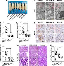 Diabetic Nephropathy