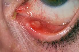 chalazion on the lower eyelid stock
