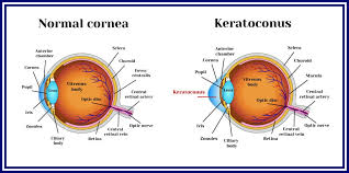 Corneal Dystrophy Causes Symptoms