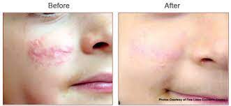 candela vbeam pulse dye laser for scars