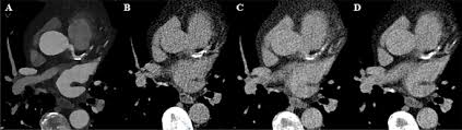 coronary calcium scoring on virtual non