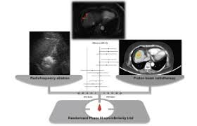 proton beam radiotherapy vs