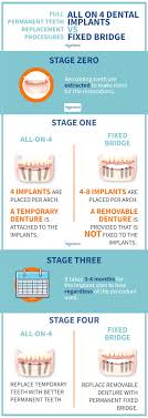 all on 4 dental implants 8 common