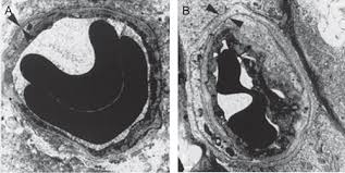 Vascular Basement Membrane Thickening