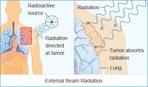 iort radiation therapy cost in india