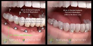 dental implants all on 4 all on 6 all on 8