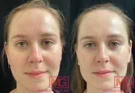 vbeam before after photos dr