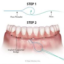 flossing daily around implants will