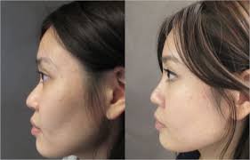 asian nose surgery before and after