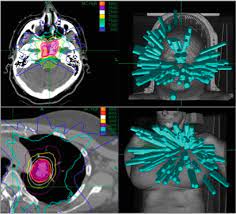 cyberknife an overview