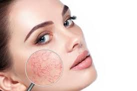 vbeam laser rosacea treatment with