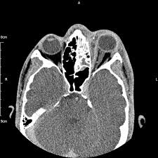non traumatic carotid artery dissection