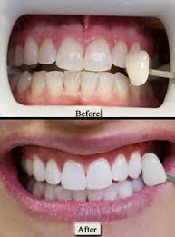 opalescence teeth whitening shannon