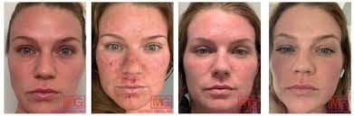 laser treatment for acne acne scars