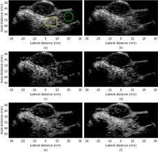 cal ultrasound imaging