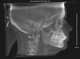 cone beam computed tomography airway