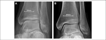 a mortise view ankle plain radiographs