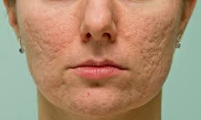 acne scars laser treatment boston