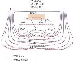 electron beam therapy dosimetry