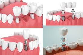 dental implants vs dental bridges