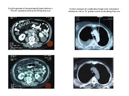 metronomic vinorelbine monotherapy