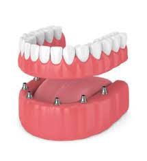 dental bridge vs implant pros cons