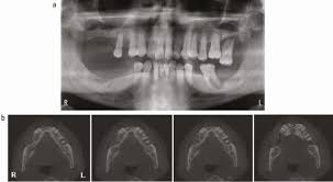 the role of cbct in implant dentistry