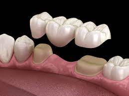 porcelain bridges dentist shadyside