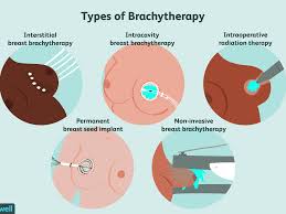 brachytherapy for early stage t cancer