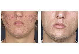 laser acne treatment vbeam