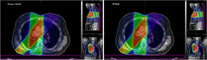 dose sment for daily cone beam ct