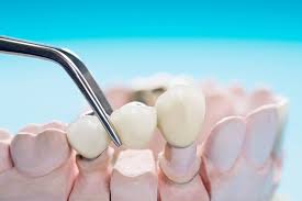 dental implant vs bridge know your