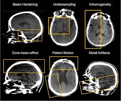 brain cone beam ct imaging artifacts