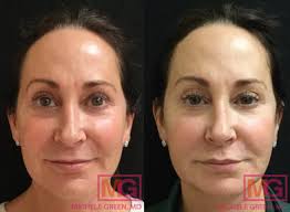 vbeam before after photos dr