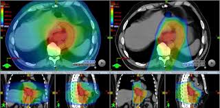 esophageal cancer