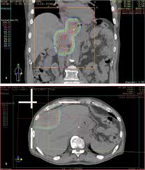 proton beam therapy