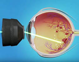 retinal laser surgery assil eye