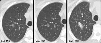 Ground Glass Pulmonary Nodules Their