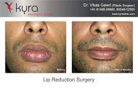 lip reduction surgery in australia